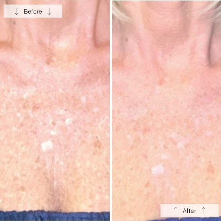 Omnilux Contour Neck & Décolleté
